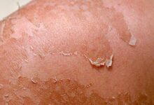 سرطان الجلد قد يحدث نتيجة التعرض لأشعة الشمس الضارة