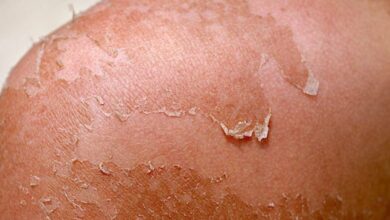سرطان الجلد قد يحدث نتيجة التعرض لأشعة الشمس الضارة